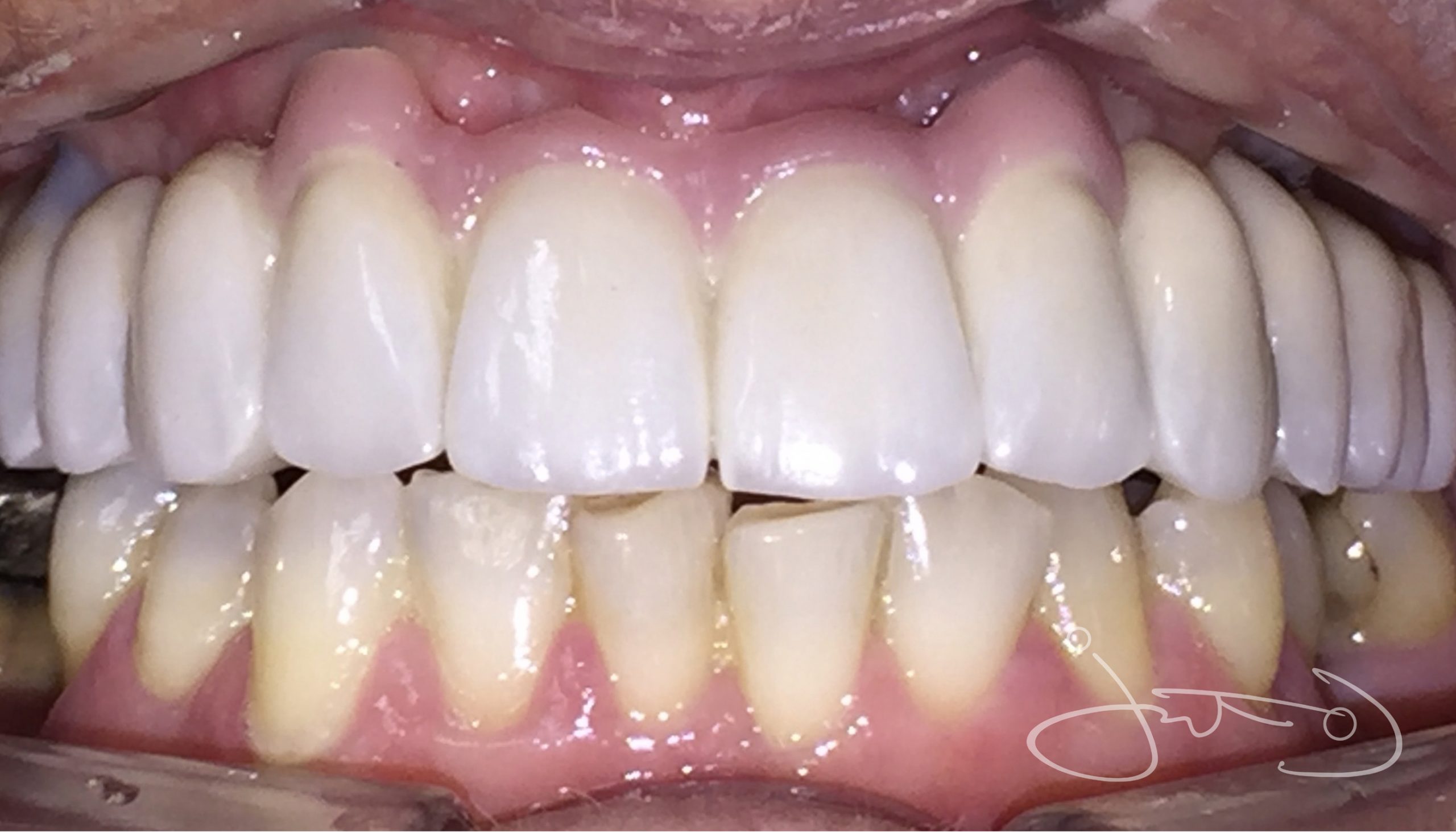 dental implants rehabilitation in Thurlow Dental