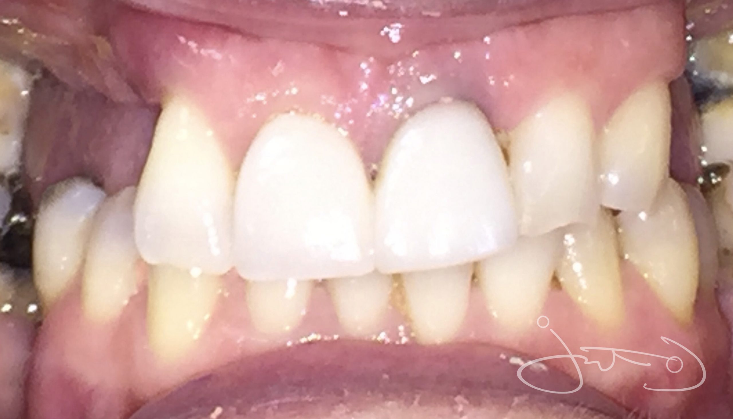 Before