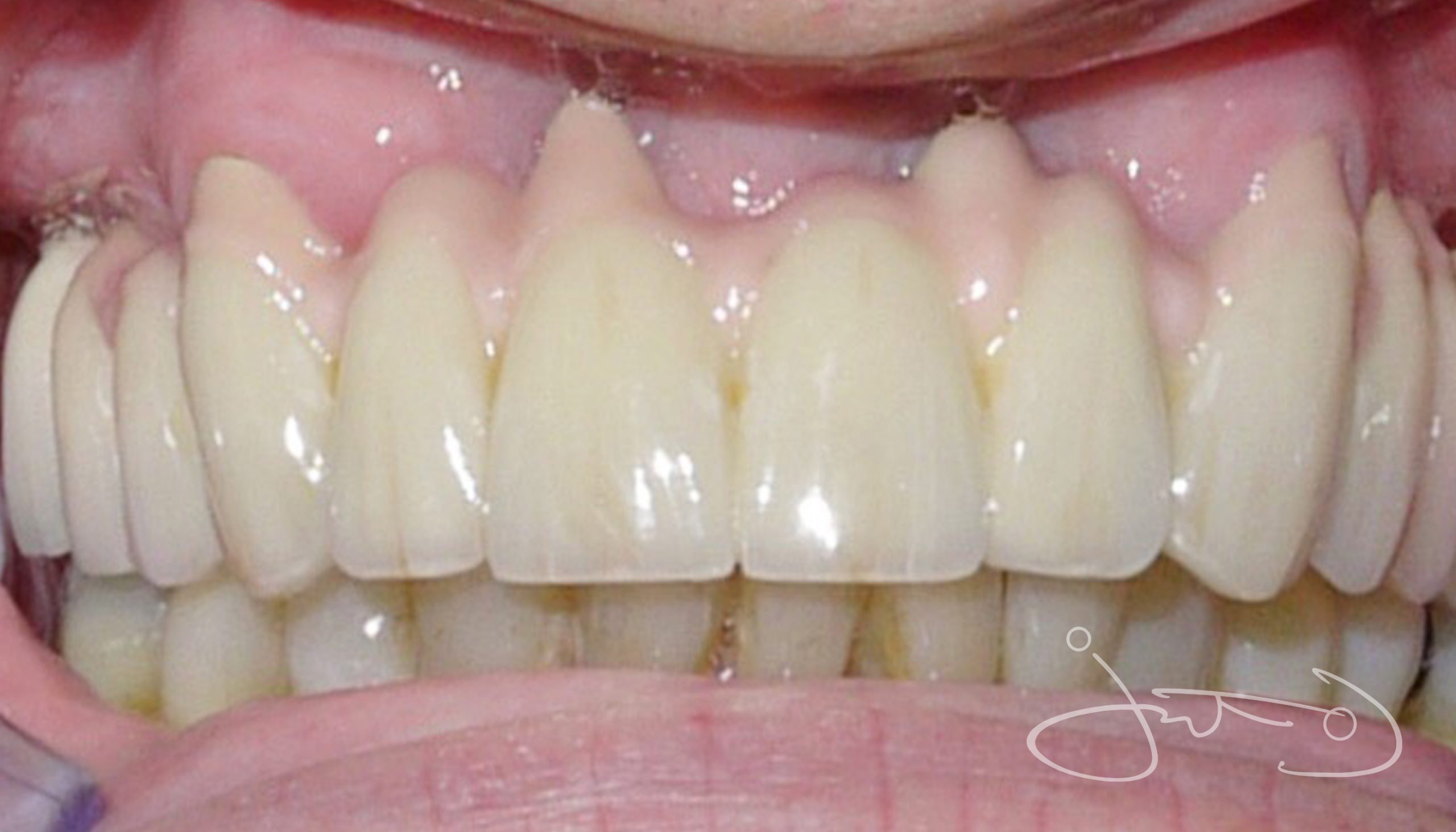 dental implant rehabilitation in Thurlow Dental case 3