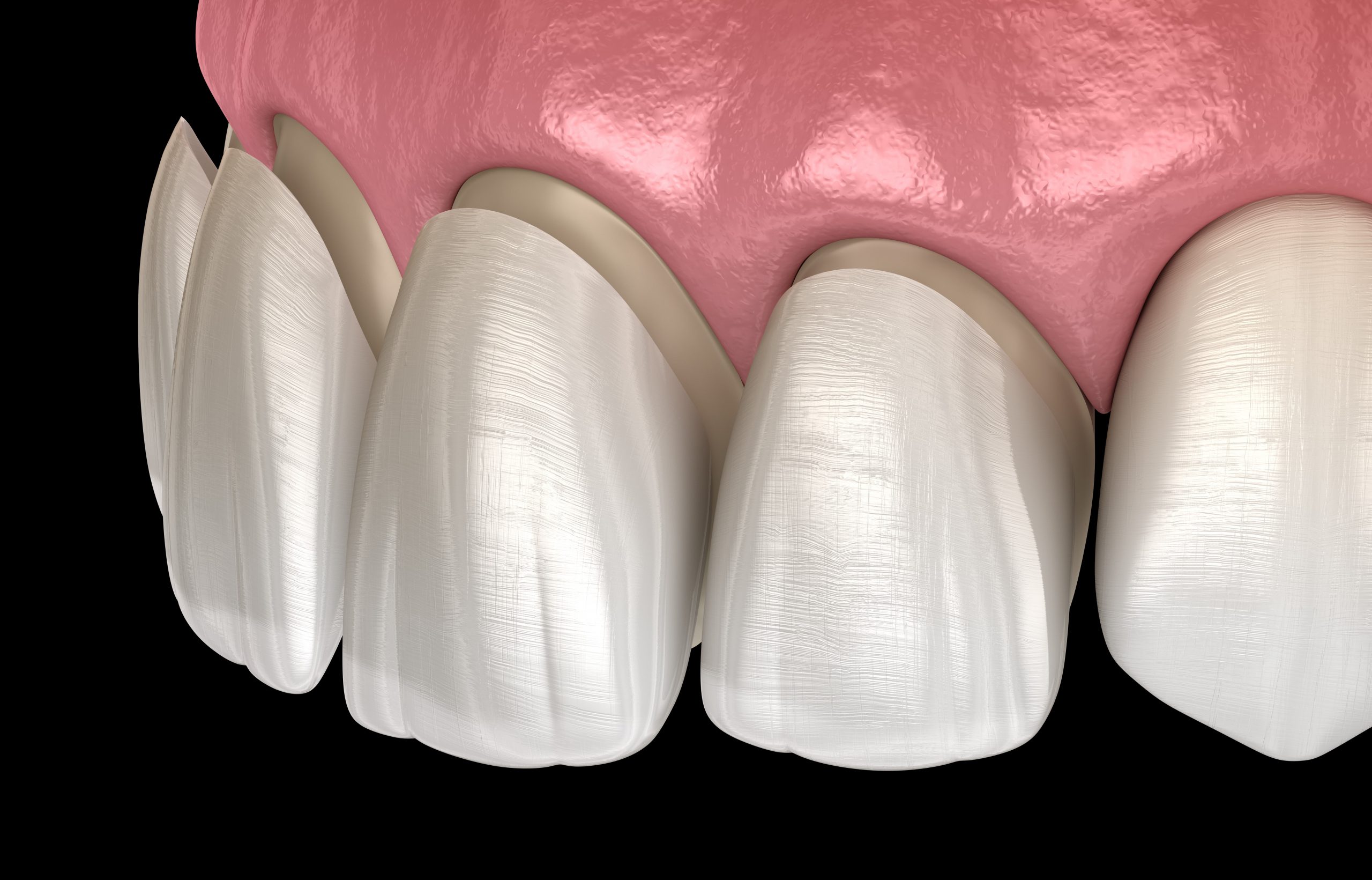 Veneer - usually cover the front facing surface of a tooth and is bonded onto the tooth