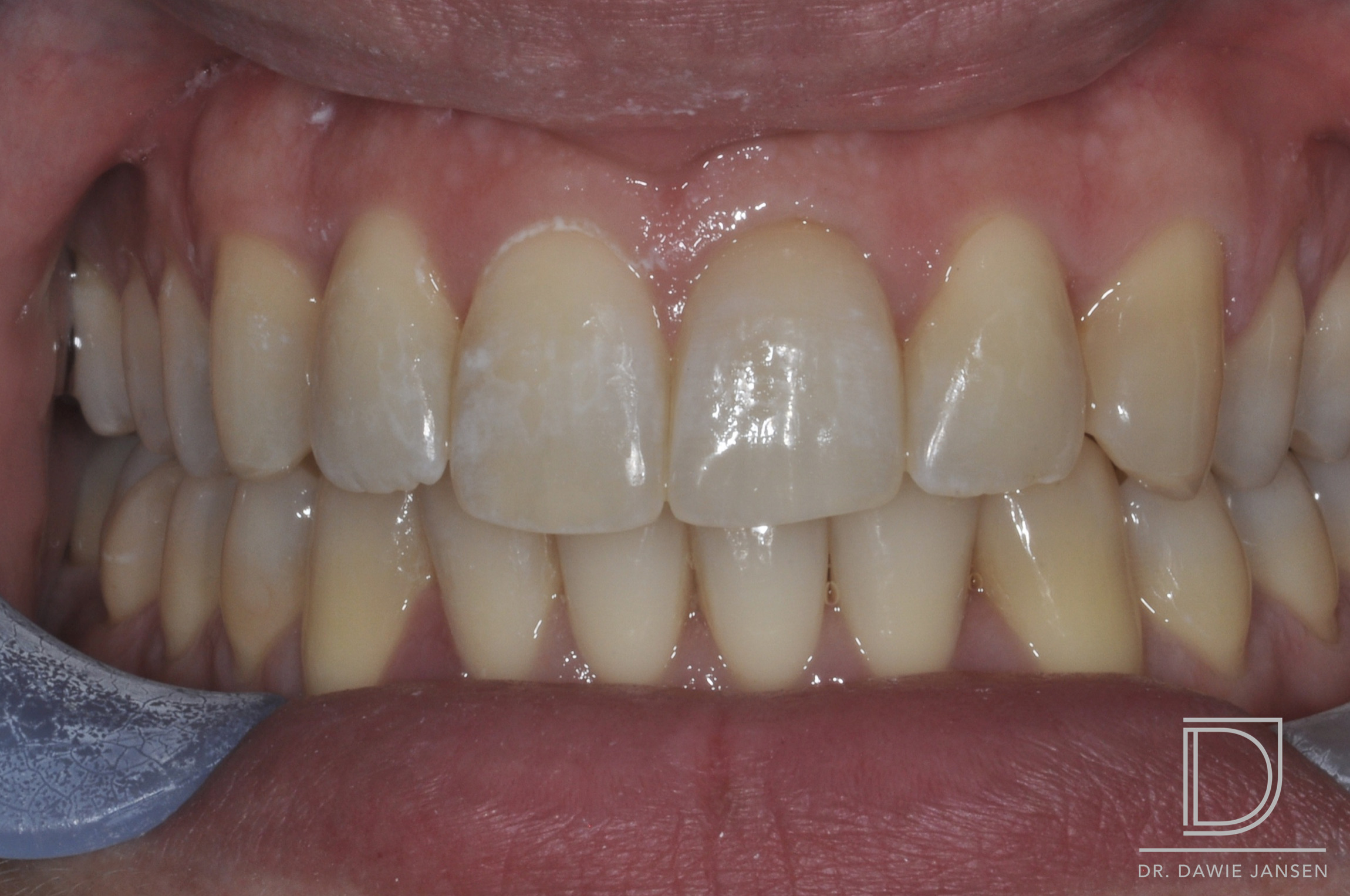 Thurlow Dental Care after teeth whitening and invisalign